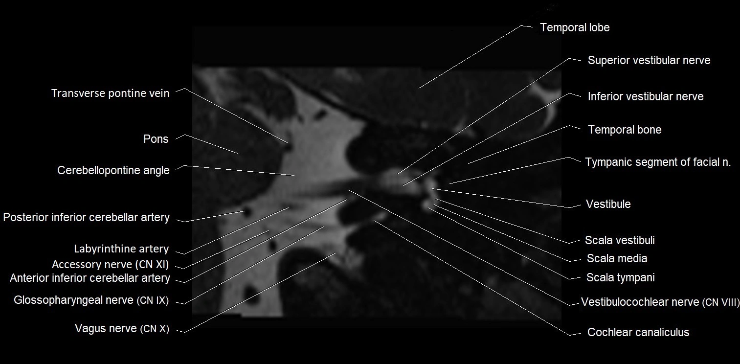 MRI Internal auditory meatus (IAM) coronal cross sectional labelled anatomy image 14.webp
